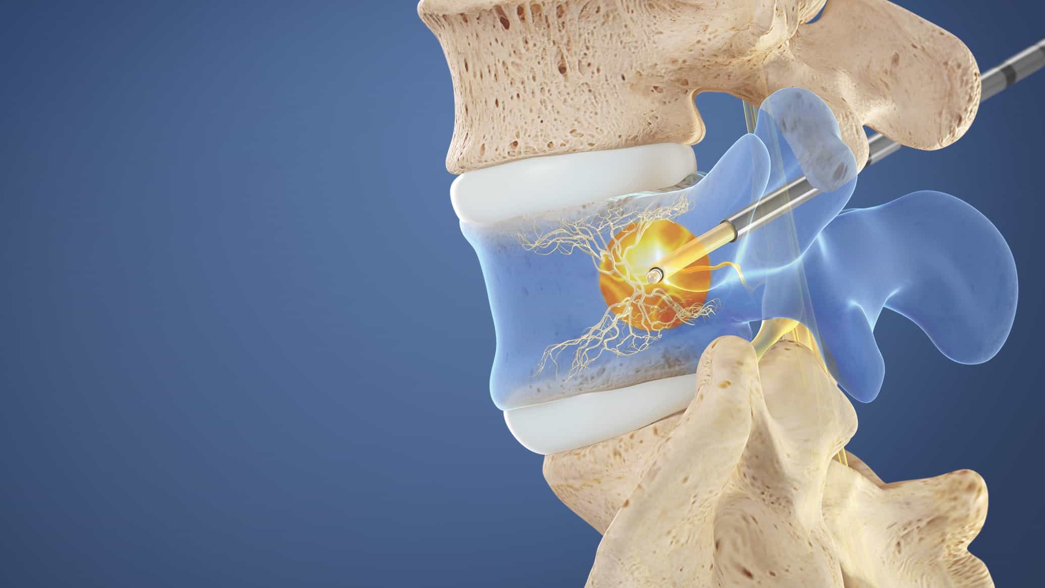 How painful is back nerve ablation?