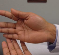 Physician holding tiny Sprint peripheral nerve stimulation lead the size of a human hair.