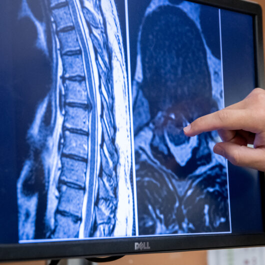 Spinal Injections Facet Joint Injections Denver Pain Experts