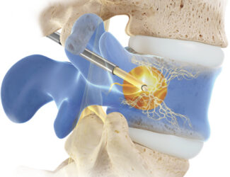 Illustration of Intracept procedure for low back pain performed in a Colorado spine center.