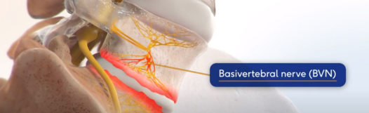 Intracept procedure video for patients.