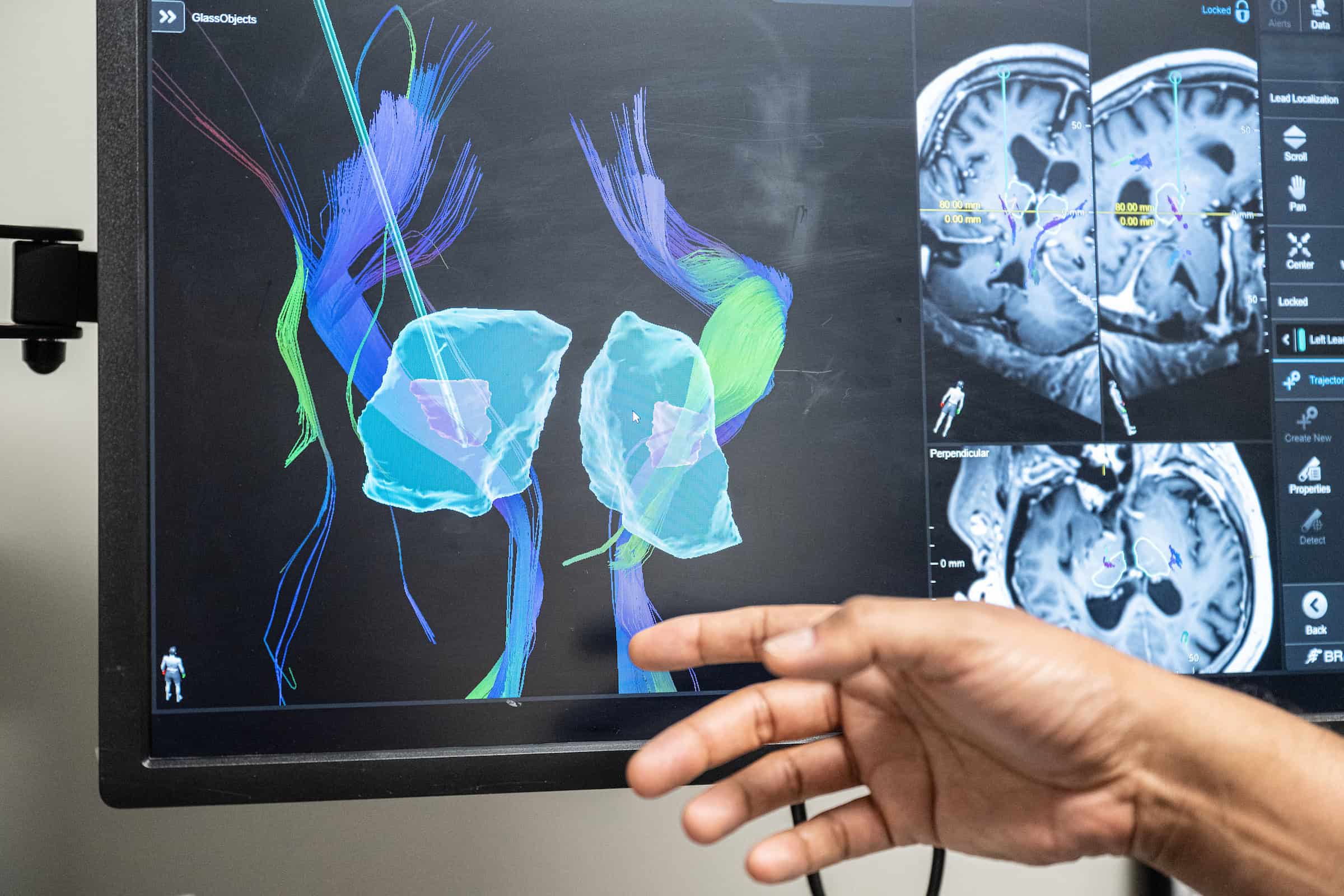 Dr. G explains the mapping of the brain for DBS