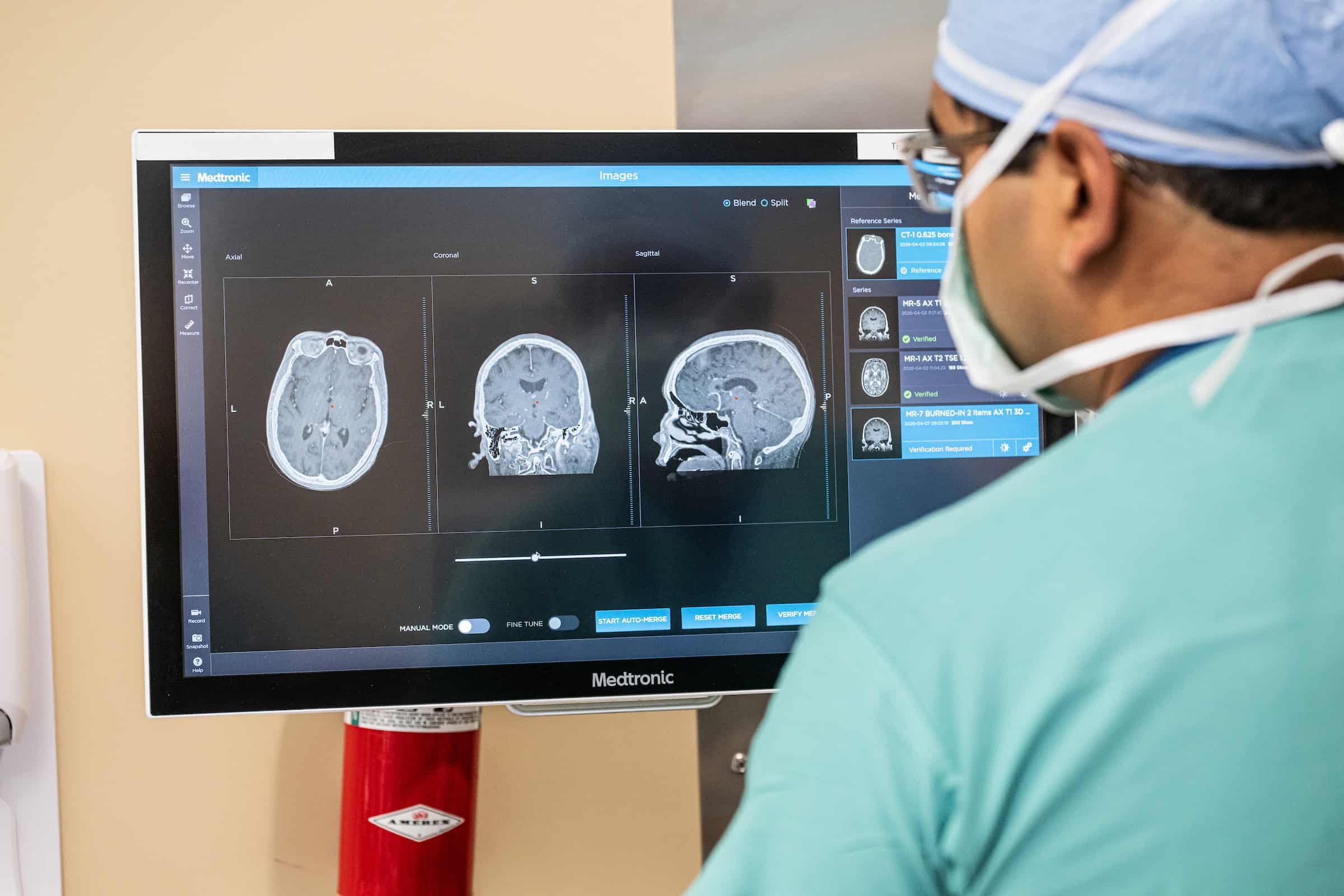 Advanced mapping improves accuracy in DBS surgery